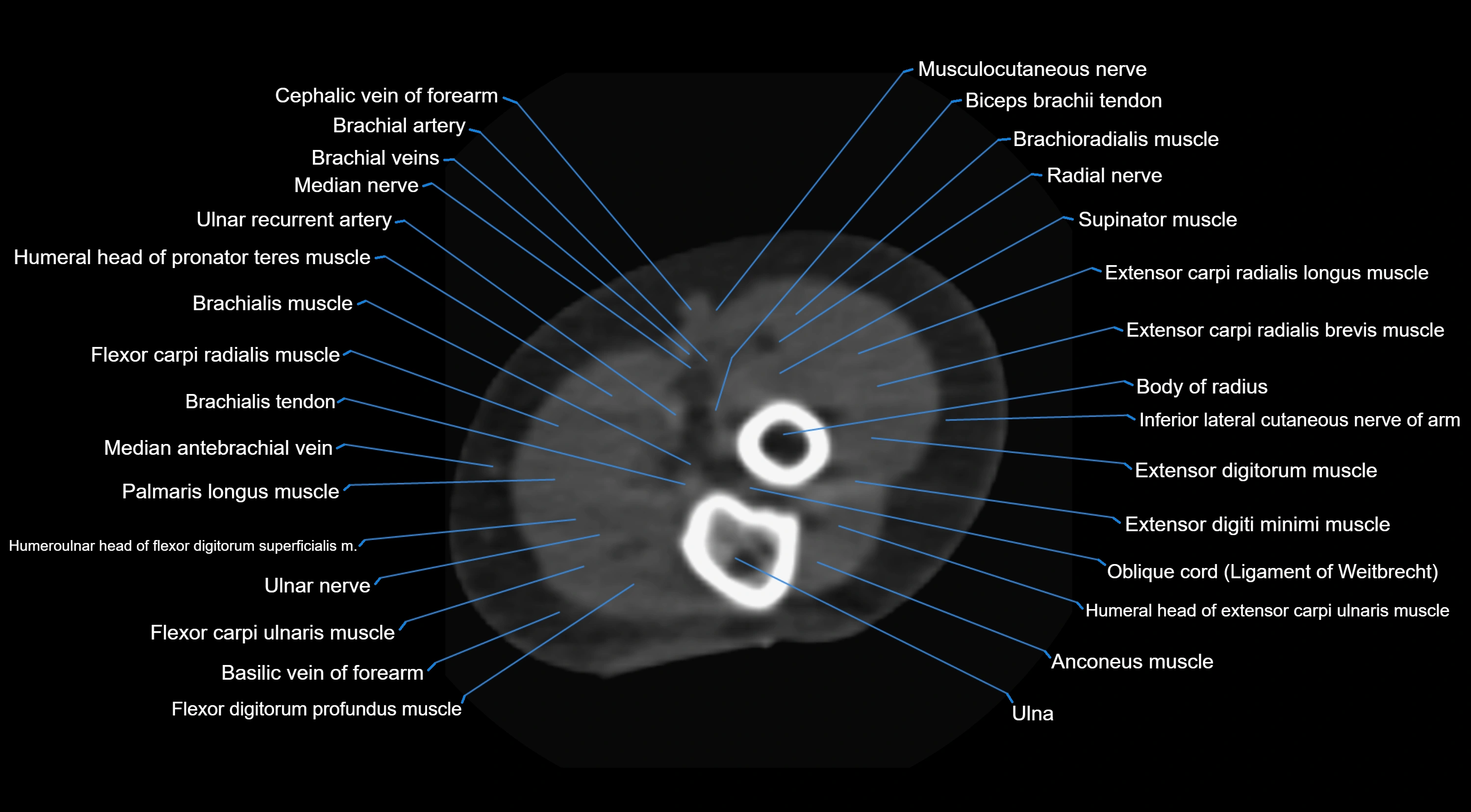 CT elbow axial  cross sectional anatomy labelled  radiology image -00038.webp